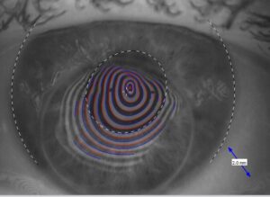 Sklerallinsenanpassung nach einer Hornhaut-Transplantation mit tiefliegendem Hornhaut-Transplantat