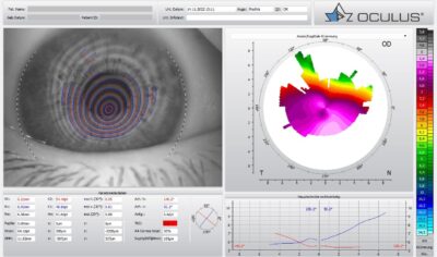 Stark fortgeschrittener Keratokonus