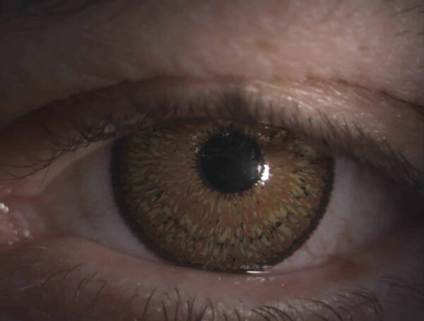 Irislinse mit Fotodruck Irislinse_2