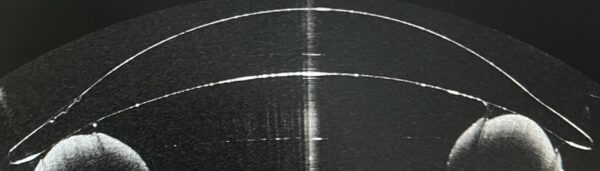 Dicke formstabile Aphakielinse Formstabile Aphakielinse mit sehr dicker Mittendicke