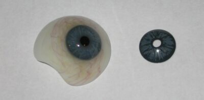 Anfertigung einer grenzlimbalen formstabilen Irisprintlinse zur kosmetischen und visuellen Rehabilitation nach Vorlage eines Glasauges am Partnerauge
