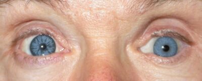 Irisprintlinse am rechten Auge und Glasauge links