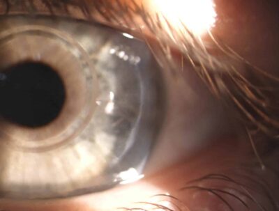 Peripherer Schnitt zur Implantation des Myorings