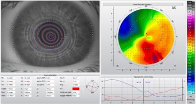 Topographie nach Implantation des Myorings