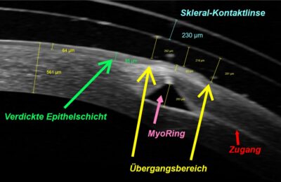 Epitheldicke über einer angepassten Sklerallinse