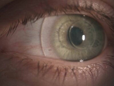 Sklerallinse zur optischen Rehabilitation bei einer Hornhaut nach Myoring-Implantation