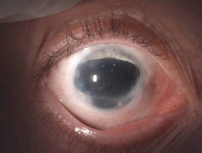 Auge nach schwerer Verletzung mit starker Blendung bei großem Irisdefekt und einem abgerutschtem Irislinsendiaphragma als Intraokularlinse