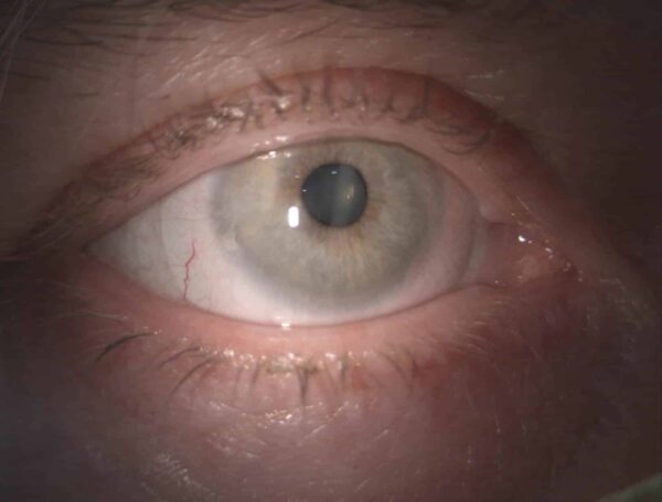 Verringerte Durchblutung der neugebildeten Hornhaut-Blutgefäße dank Verwendung einer Sklerallinse