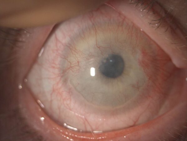 Neovaskularisationen der Hornhaut