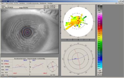 Starke Hornhautunregelmäßigkeiten im Topographiebild zu sehen