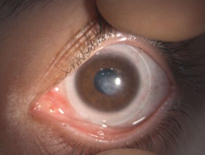 Sklerallinse bei starker zentraler Vernarbung der Hornhaut ermöglicht besseres Sehen