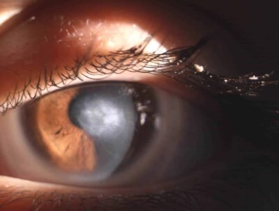 Zentrale Hornhautnarben führen zu stärkerer Blendung, die mit einer Sklerallinse verringert werden kann