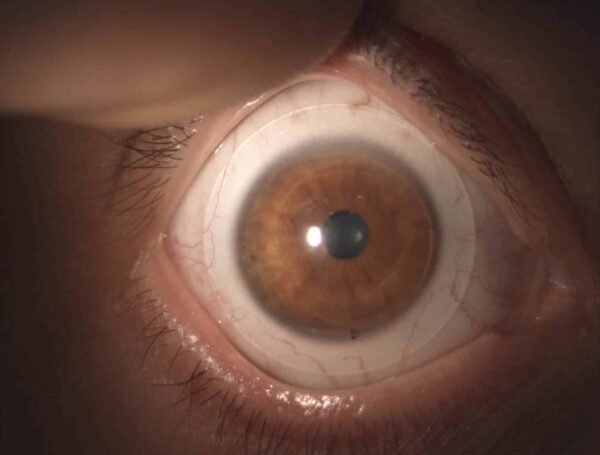 Übersichtbild einer Freiform-Sklerallinse mit Markierungen