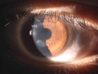 Hornhaut mit Stromanarben