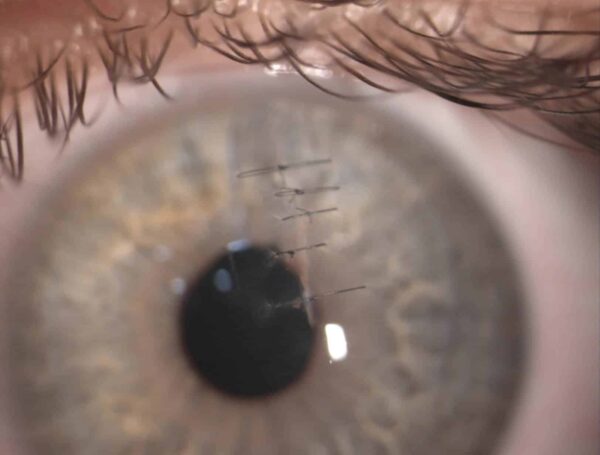 Einzelknüpfnähte an der Hornhaut nach Hornhautperforation