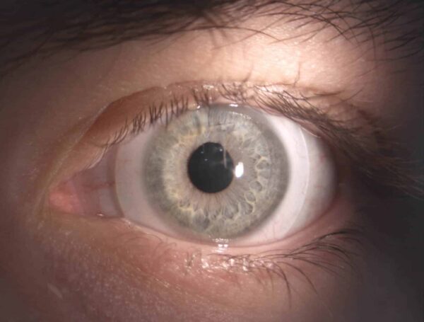 Übersichtsbild der Sklerallinse auf der Hornhaut und sklerale Auflagebereiche