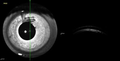 Man erkennt die Fäden der Hornhautnähte und mit sicherem Abstand darüber die Sklerallinse