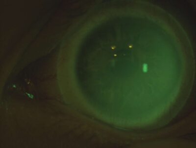 Beurteilung der Tränenfilmdicke anhand der Anfärbung mittels Fluoreszeins