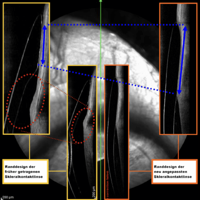 Vergleich der Randdesigns von Sklerallinsen