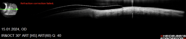 Sanfte und perfekt parallele Auflage einer Sklerallinse am Auge