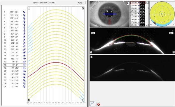 25 Schnittbilder der Pentacam AXL Wave des Corneo-Skleral-Profils ergeben einen 3D-Augenabdruck