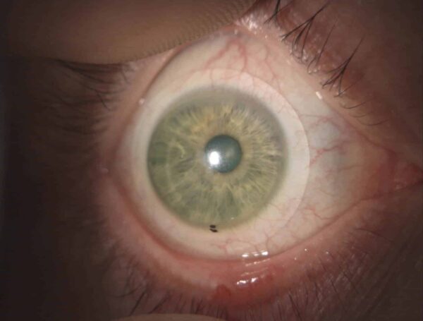 Individuelle Sklerallinse in Freiformtechnik liegt sanft auf der Bindehaut auf für einen optimalen Tragekomfort der Linse.