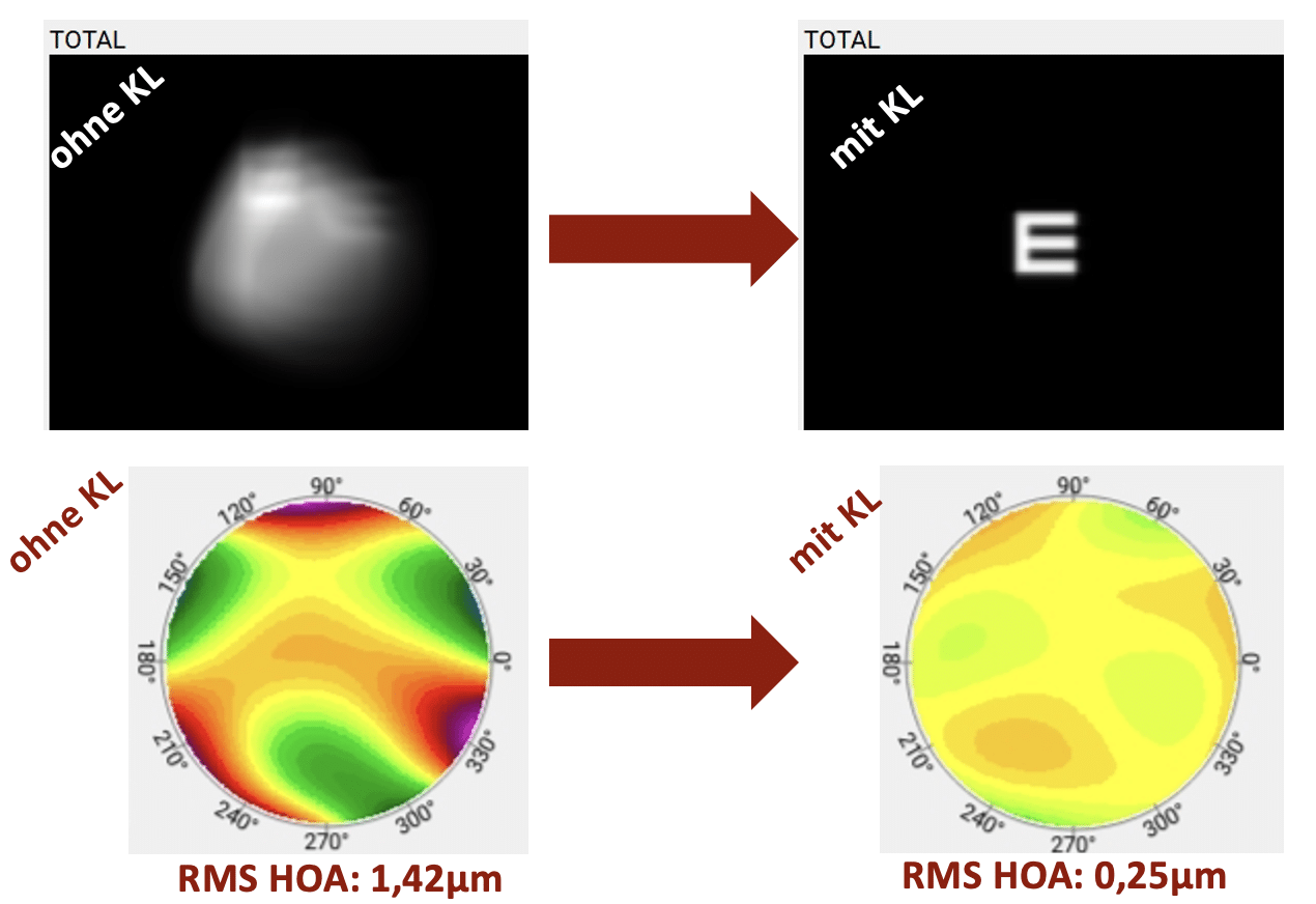Abbildungsfehler höherer Ordnung bei Sklerallinsen Reduktion von Abbildungsfehler Höherer Ordnung mit einer Sklerallinse